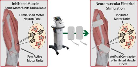 (PDF) ELECTRICAL MUSCLE STIMULATION: THE EFFECTS ON  .